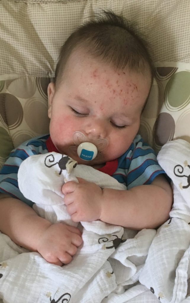 my son snuggling while sleeping with scratches all over his little face due to eczema