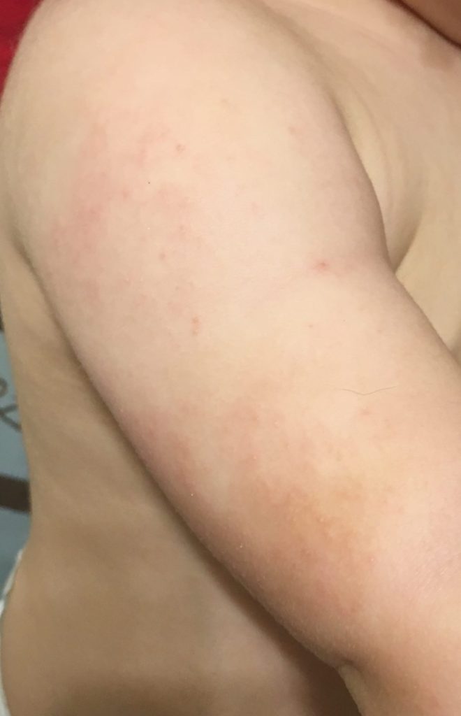 my son's little itchy arm