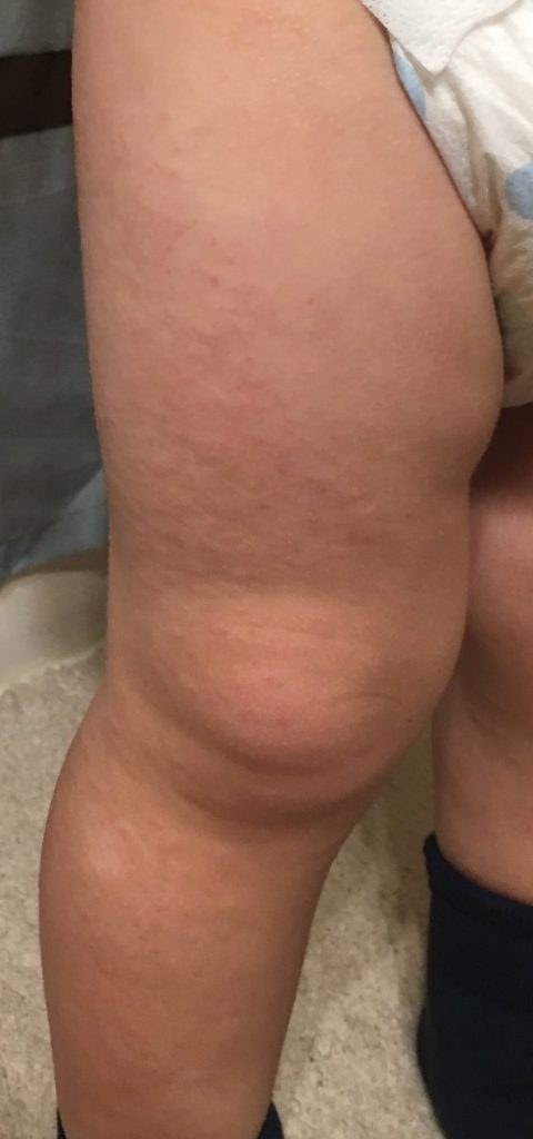 eczema on my son's leg 