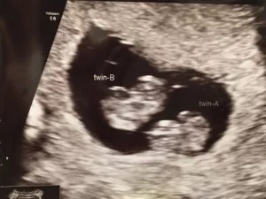 8wks preg twins ultra edited