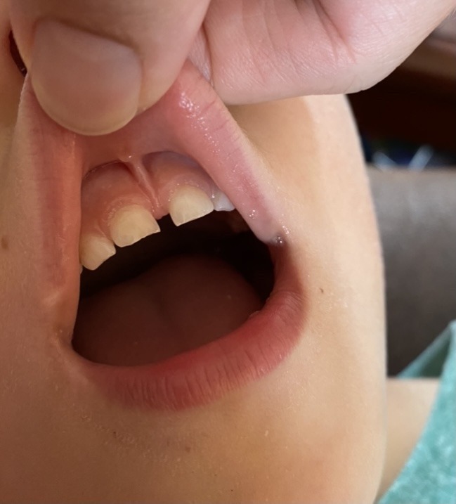 Oldests Lip Tie results in tooth gap