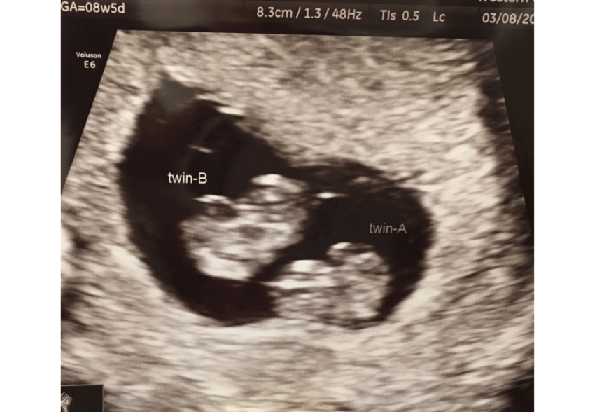 8 Weeks But Measuring 6 Weeks 8 Weeks Pregnant with Twins: The Week I Found Out I Was Carrying Twins