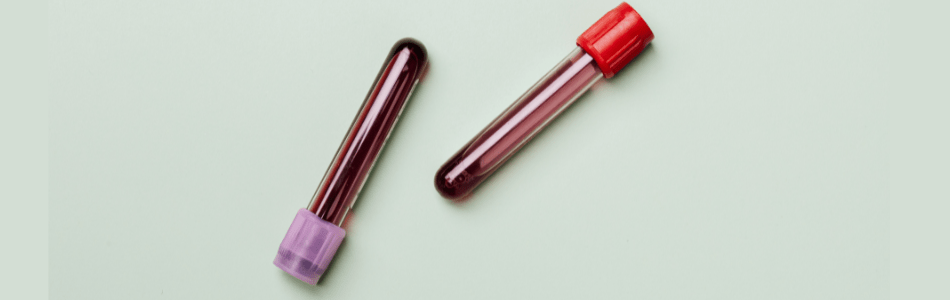 Hashimotos vials of blood for testing